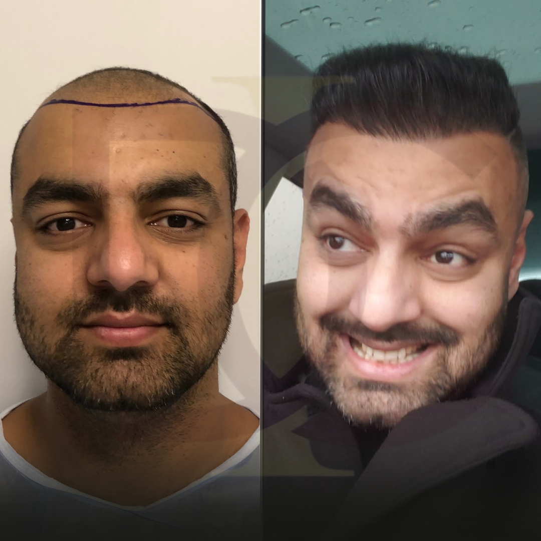 BEFORE (Instagram Gönderisi (Kare)) Kopyası Kopyası Kopyası