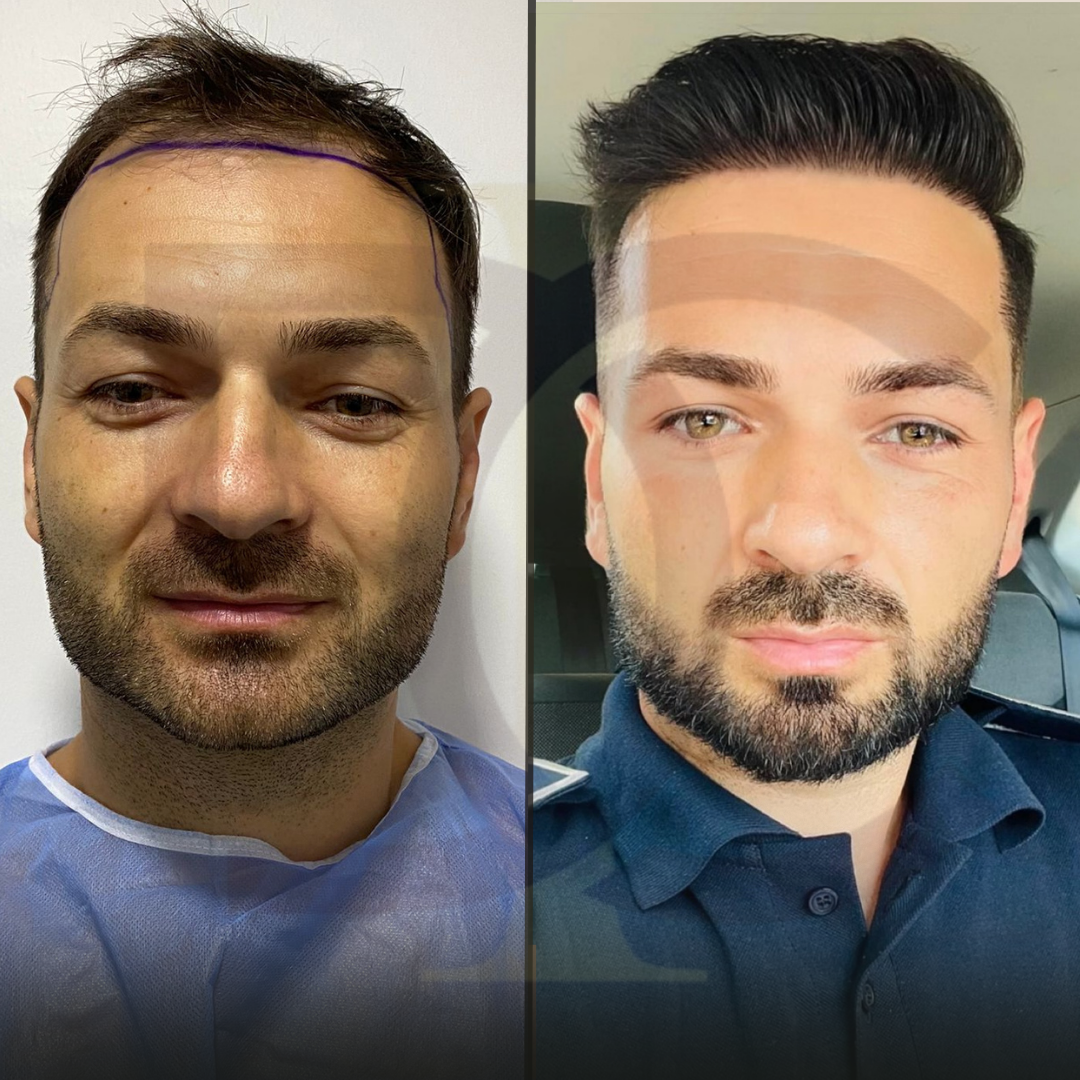 BEFORE (Instagram Gönderisi (Kare)) Kopyası Kopyası