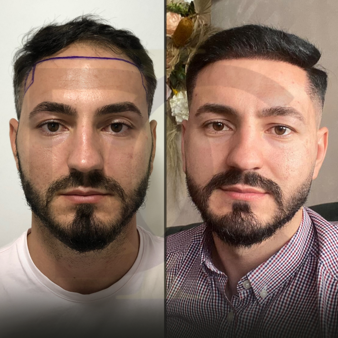 BEFORE (Instagram Gönderisi (Kare)) Kopyası